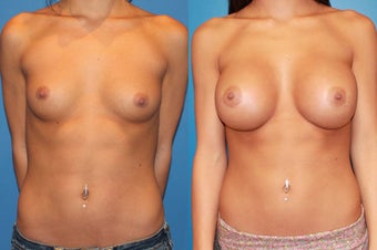 Breast Augmentation before 310714