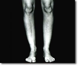 Calf Implant before 566015