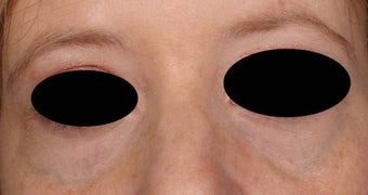 Blue veins around eyes before 135045
