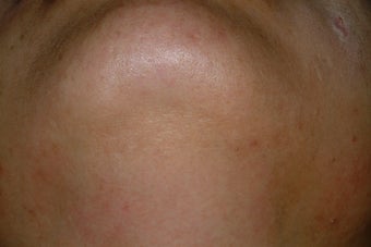 Chin folliculitis and LHR after 86769