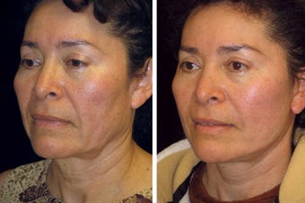 51 Year old female facelift before 617331