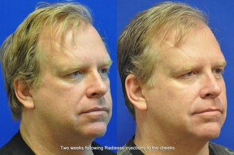 Radiesse Injection in Cheeks after 403466