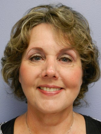 Neck Lift 598886
