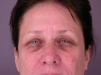 Brow Lift before 306415
