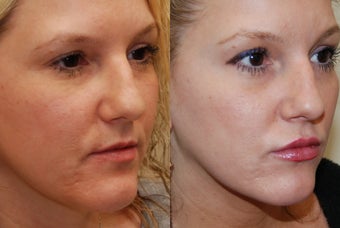 Lip Augmentation with Silikon-1000. 2 treatments. before 487939