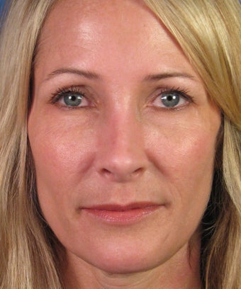 Revision Rhinoplasty after 410807