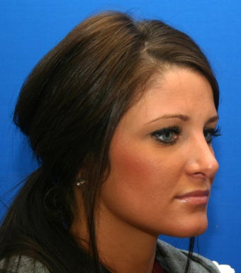 Rhinoplasty (nose job) 532519