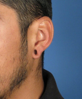 Gauge Earring Repair Otoplasty Surgery 617423