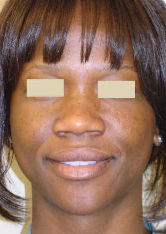 African American Rhinoplasty before 104225