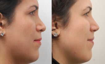 Revision Rhinoplasty before 468268