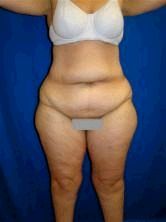 Extended Tummy Tuck Surgery before 147833
