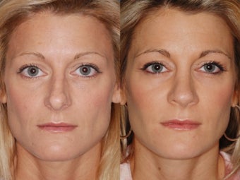 Revision rhinoplasty before 334284