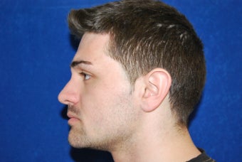 Endoscopic Brow Lift and Rhinoplasty 541221