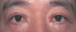 Eyelid Surgery after 154210