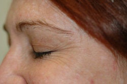 Botox for Crow's Feet before 91056
