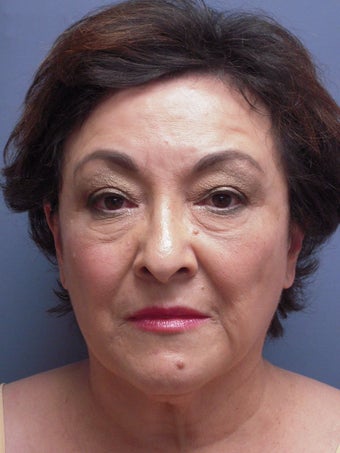 Neck Lift, Platysmaplasty before 634736