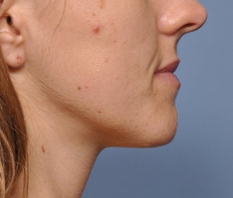 Chin Reduction 521959