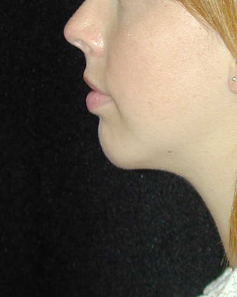Chin Implant after 101322