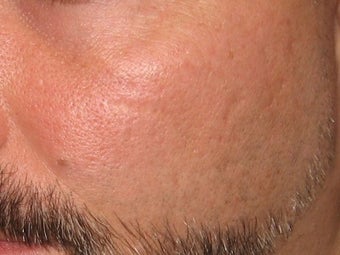 CO2 Fractionated Laser Resurfacing. before 272014