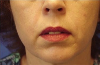 Juvederm after 481437