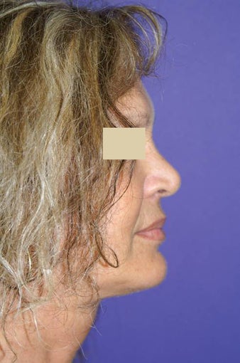 Neck sling procedure after 135676