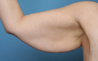 Arm Lift 544868