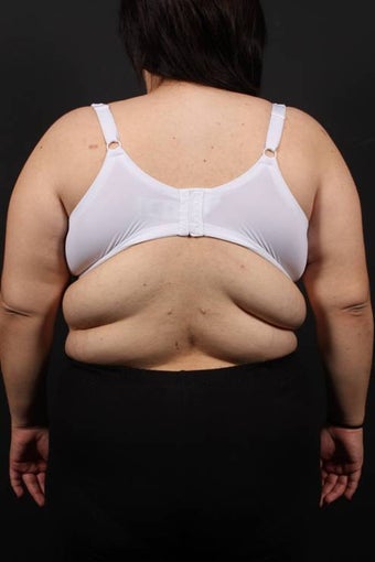 Bra Line Back Lift before 472813