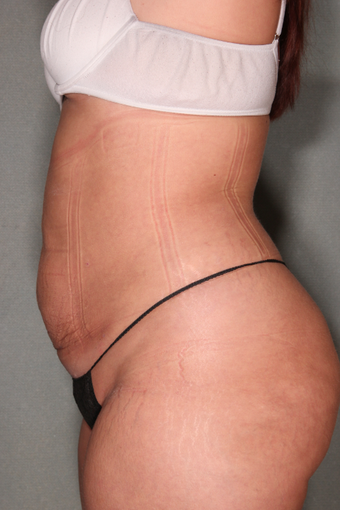 SmartLipo™ 529476