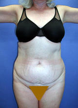 Abdominoplasty Surgery before 131919