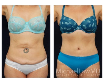 Abdominoplasty - Tummy Tuck before 629026