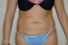 Tummy Tuck before 215069