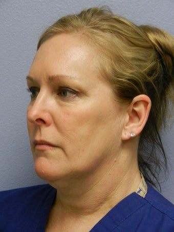 Laser Liposuction before 555894