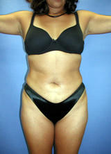 Liposuction Surgery after 123633