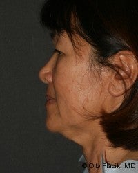 Neck Lift 567432