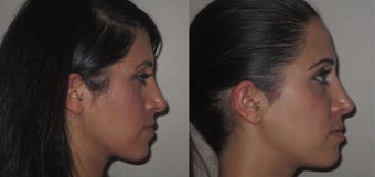 Facial Rejuvenation, non-surgical 450123