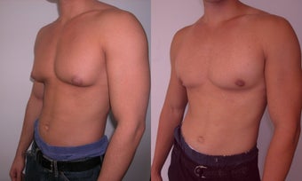 Gynecomastia after 341117