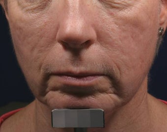 Fraxel - acne scars before 136193