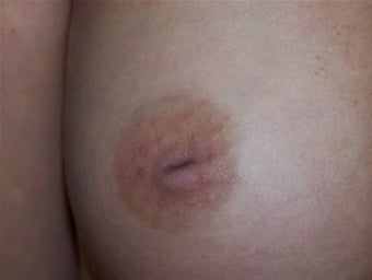Inverted Nipple Repair before 157930