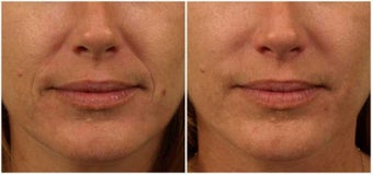 Restylane before 325525