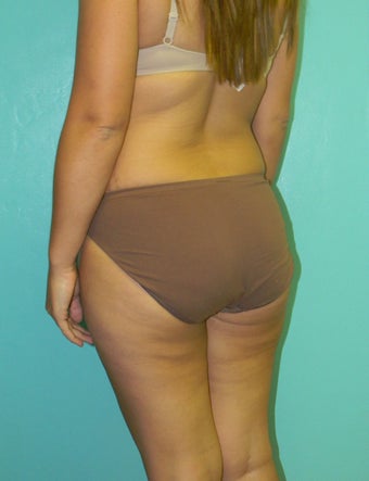 Brazilian Butt Lift- Fat Transfer before 372638