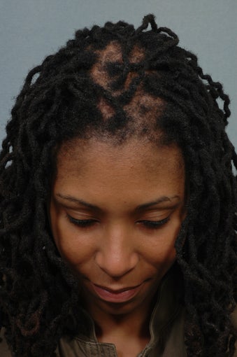Hair Transplantation 358867