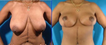 Breast and Body Lift before 102721
