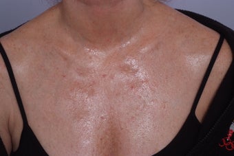 decollete laser resurfacing before 253111