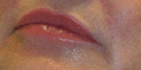 Restylane after 272044