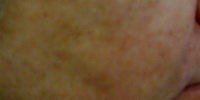 Severe Acne Rosacea Treatment after 272037