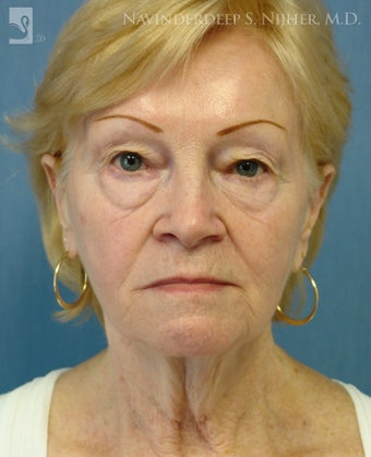 Facelift, Eyelid Surgery & Chin Implant before 501561