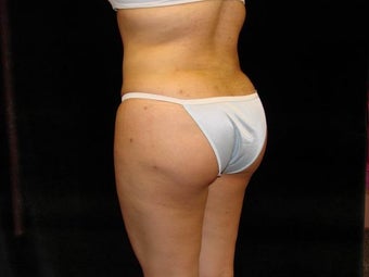 Buttocks Augmentation 517511