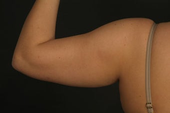 Liposuction 315604