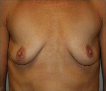 Breast Augmentation before 110453