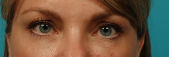 Restylane Filler for cheeks and eyes after 286176